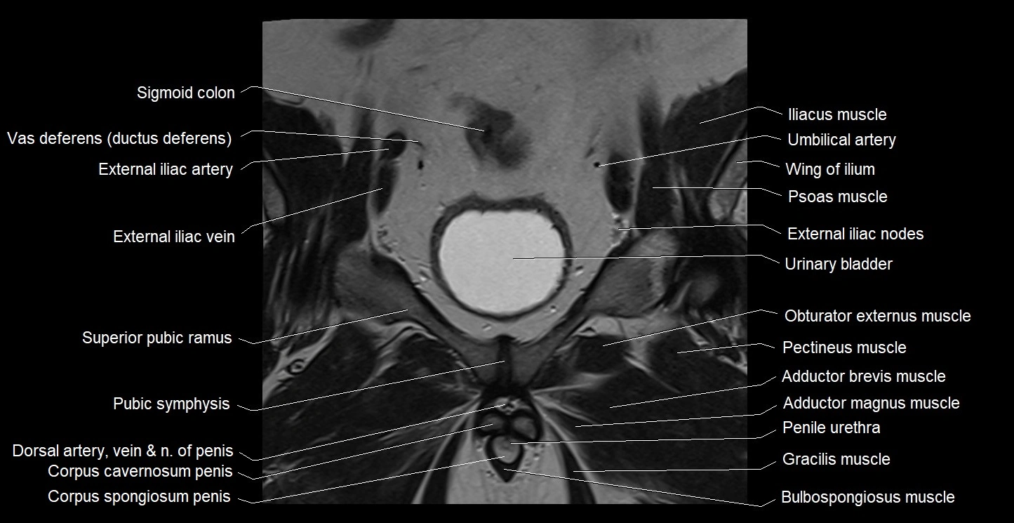 MRI coronal cross sectional anatomy male pelvis image 13.webp
